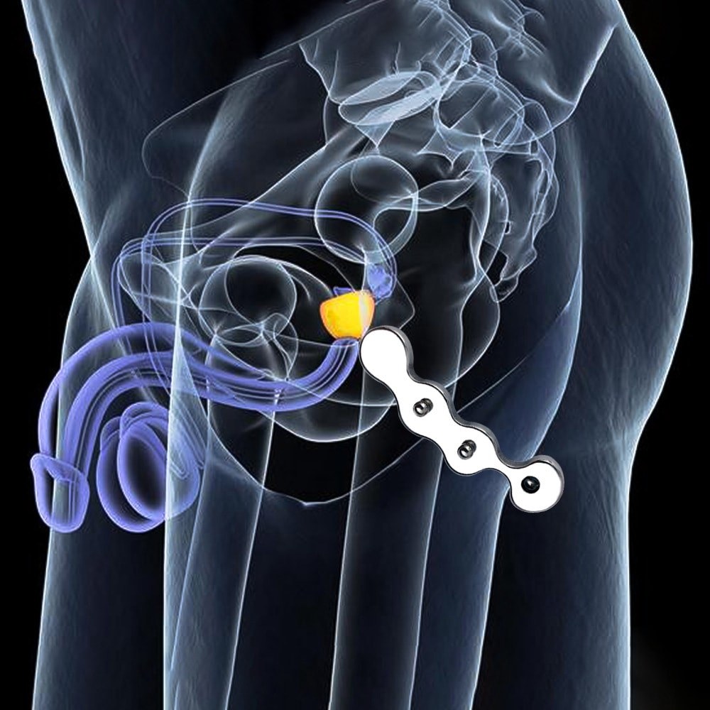 Ball Beads Prostate Plug